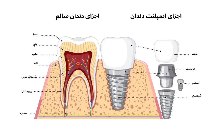 اجزای ایمپلنت دندان- اجزای دندان-کلینیک دکتر افشین میرزایی