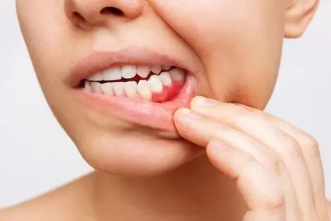 انواع بیماری لثه- دنداغنپزشکی تهرانپارس- کلینیک دکتر افشین میرزایی