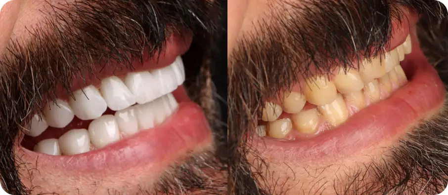 اصلاح طرح لبخند، لمینت دندان دکتر افشین میرزایی-دندانپزشکی تهرانپارس