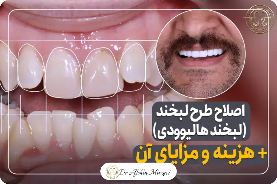 اصلاح طرح لبخند هالیوودی + هزینه و مزایای آن