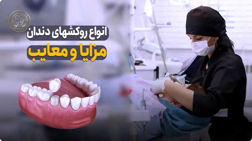 انواع روکش های دندان مزایا و معایب آن