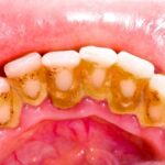 دندان پزشکی و جرم گیری