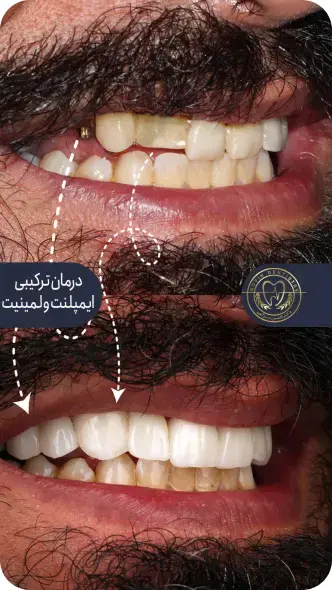 کاشت ایمپلنت دندان-دکتر افشین میرزایی