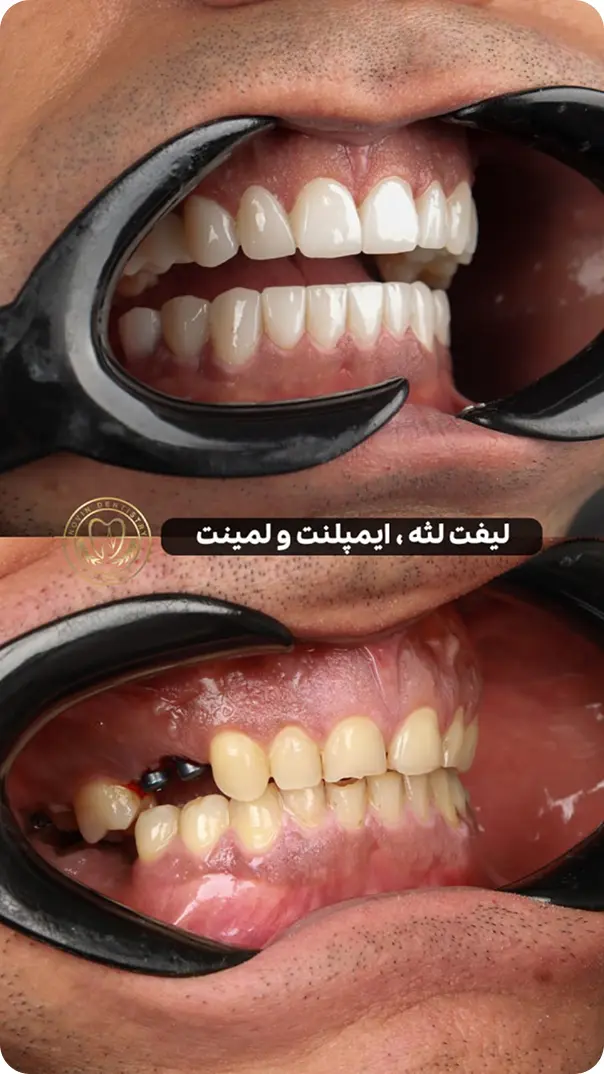 ایمپلنت دندان-دکتر افشین میرزایی
