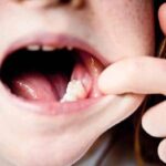 عوارض ار دست دادن دندان