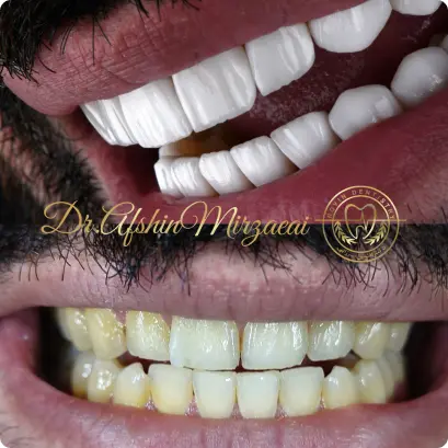 نمونه کار ترمیمی و زیبایی دکتر افشین میرزایی- دنداپزشکی تهرانپارس