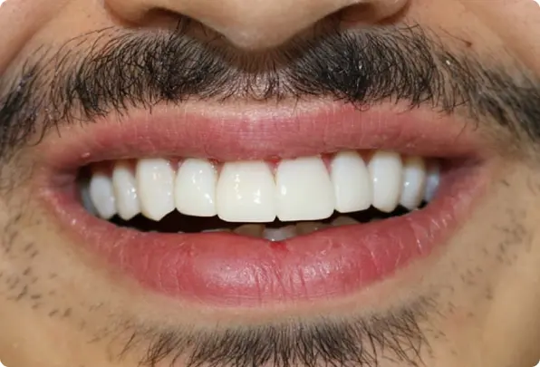 نمونه کار ترمیم دکتر افشین میرزایی