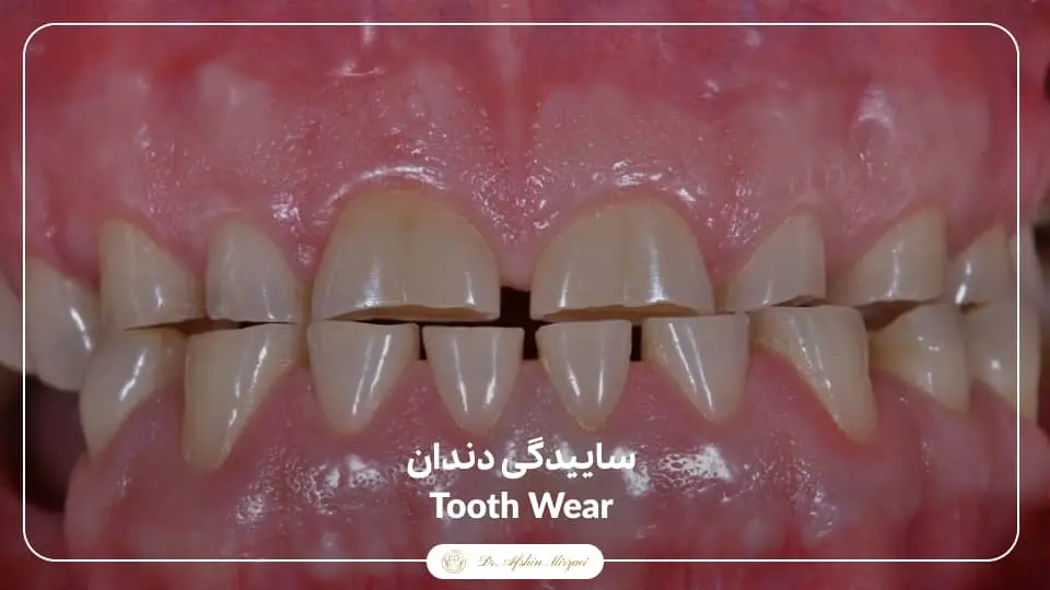 ساییدگی دندان-درمان زیبایی دندان-دکتر افشین میرزایی