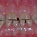 ساییدگی دندان