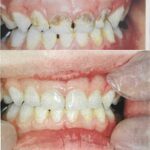 درمان پوسیدگی دندانهای شیری