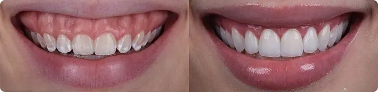 جراحی زیبایی لثi جراح دکتر افشین میرزایی