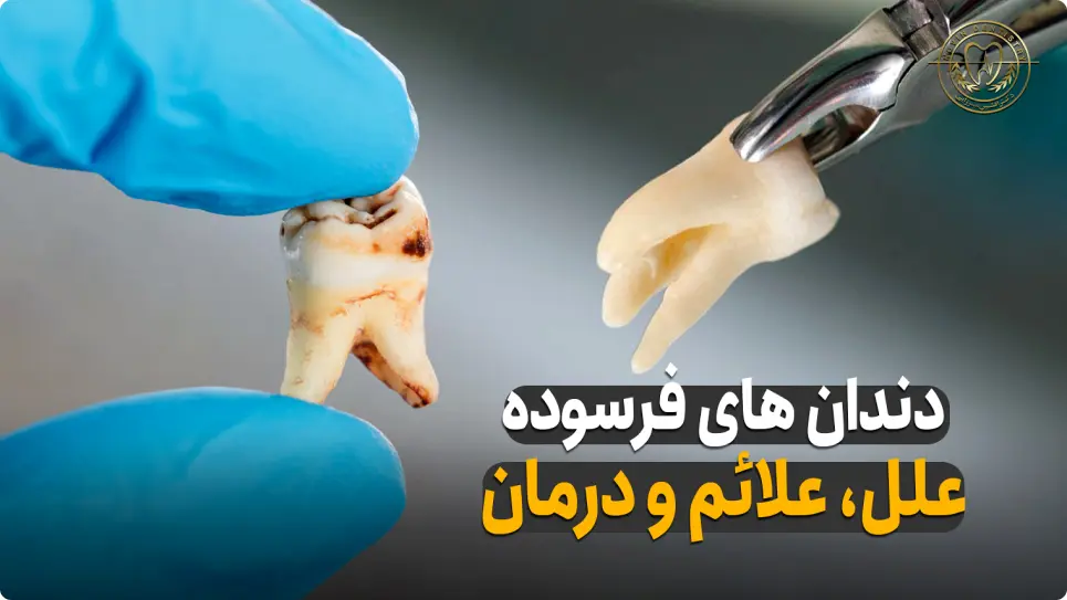دندان های فرسوده