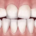 تغییر در اندازه دندان