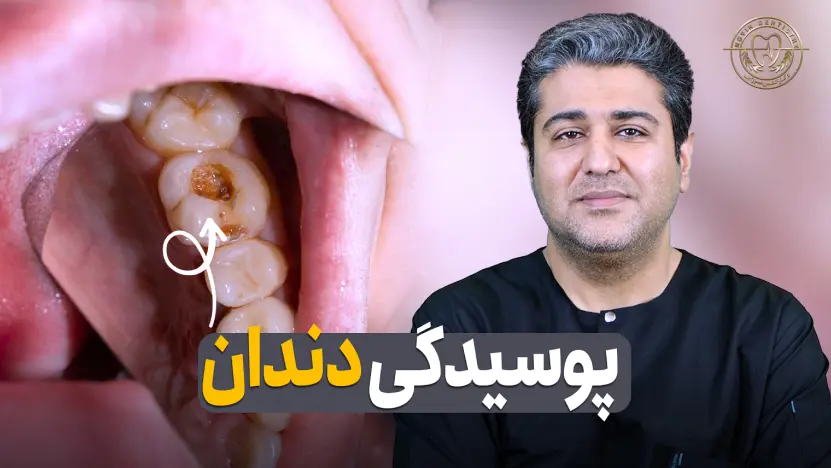 پوسدگی دندان-نکات مهم توسط دکتر افشین میرزایی