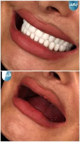اوردنچر، روکش لمینت-دکتر افشین میرزایی