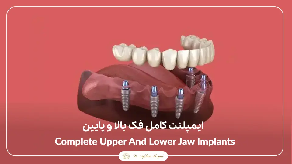 ایمپلنت کامل فک بالا و پایین