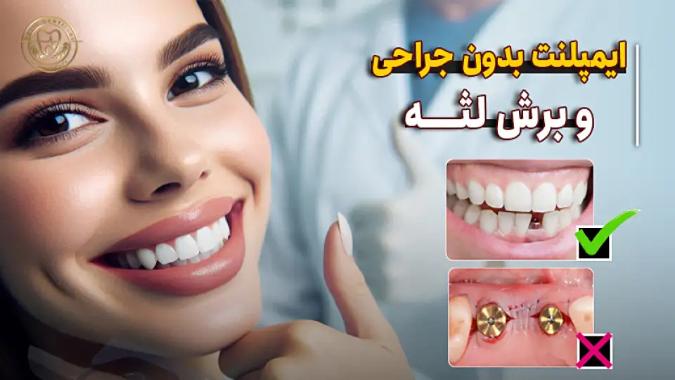 ایمپلنت بدون جراحی و برش لثه