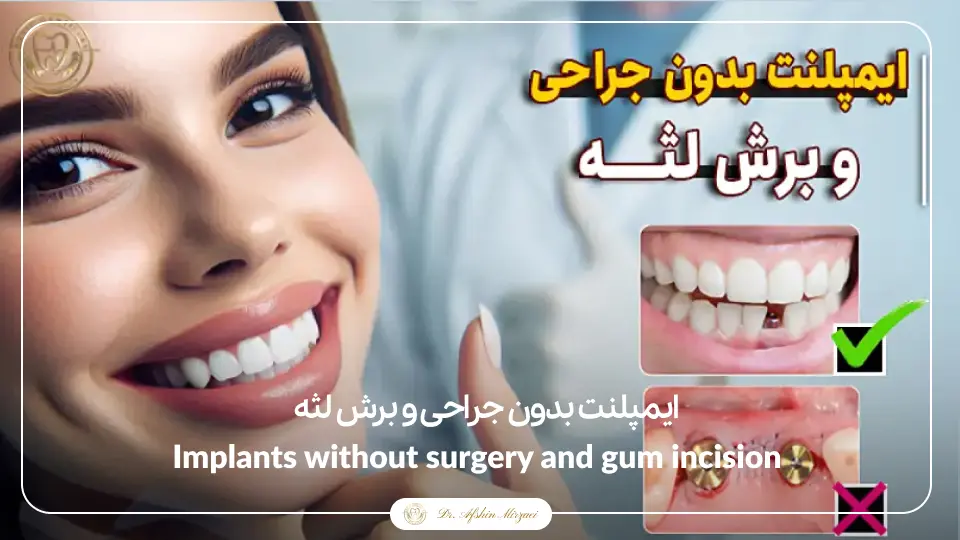 ایمپلنت بدون جراحی و برش لثه-کلینیک دندانپزشکی تهرانپارس