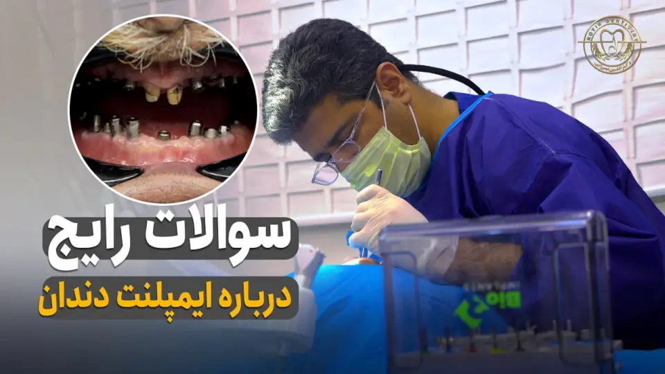 سوالات رایج درباره ایمپلنت دندان - دکتر افشین میرزایی