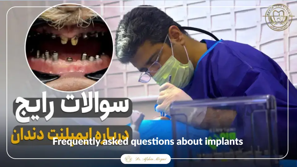 سوالات رایج درباره ایمپلنت-دکتر افشین میرزایی