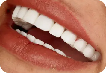 Dental crown v 1 1