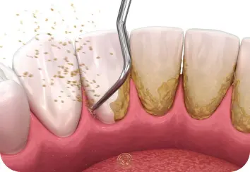 خدمات درمانی و زیبایی دندان 9 جرم گیری دندان-کلینیک دکتر افشین میرزایی