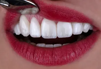 Laminate dental dr afshin mirzaei 1