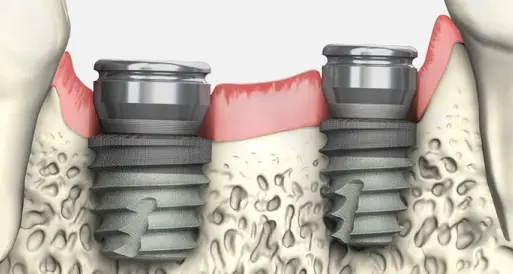 مراقبتهای پس از درمان هیلینگ ایمپلنت Oral hygiene and care of the healing area - مراقبتهای پس از درمان هیلینگ ایمپلنت | کلینیک دکتر میرزایی