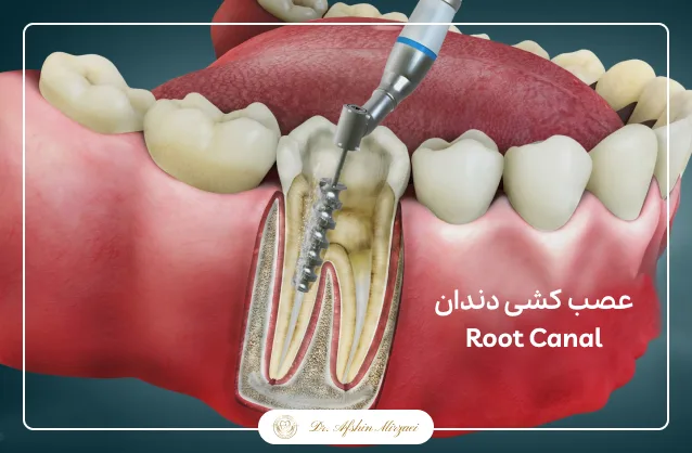 کلینیک دندانپزشکی دیجیتال دکتر افشین میرزایی-عصب کشی دندان