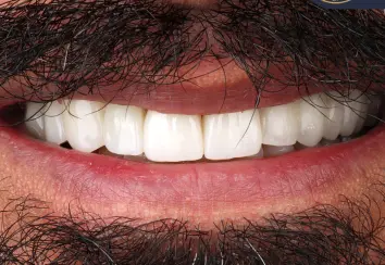 implane-dental-dr-afshin-mirzaei