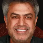 کلینیک دکتر افشین میرزایی 6 عباس ابراهیمی-فول ایمپلنت بالا و پایین توسط دکتر افشین میرزایی