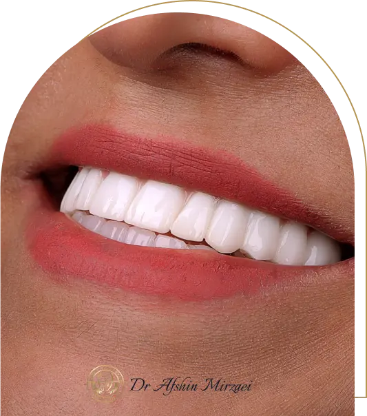 جشنواره ایمپلنت اقساطی با تخفیف ویژه + پرداخت اقساطی ۱۲ و ۲۴ ماهه! before after implant clinic tehranpars 3 - جشنواره ایمپلنت اقساطی با تخفیف ویژه + پرداخت اقساطی ۱۲ و ۲۴ ماهه! | کلینیک دکتر میرزایی