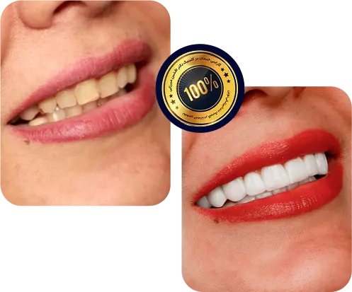 کلینیک دکتر افشین میرزایی قبل و بعد لمینت دندان-کلنیک دکتر افشین میرزایی