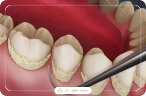جرم گیری و روت پلنینگ - دکتر افشین میرزایی