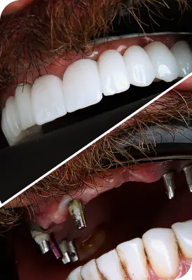 جشنواره ایمپلنت اقساطی با تخفیف ویژه + پرداخت اقساطی ۱۲ و ۲۴ ماهه! befor after implant dental ddr afshin mirzaeiv 1 1 - جشنواره ایمپلنت اقساطی با تخفیف ویژه + پرداخت اقساطی ۱۲ و ۲۴ ماهه! | کلینیک دکتر میرزایی