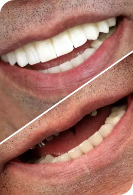 جشنواره ایمپلنت اقساطی با تخفیف ویژه + پرداخت اقساطی ۱۲ و ۲۴ ماهه! befor after implant dental v 2 1 - جشنواره ایمپلنت اقساطی با تخفیف ویژه + پرداخت اقساطی ۱۲ و ۲۴ ماهه! | کلینیک دکتر میرزایی