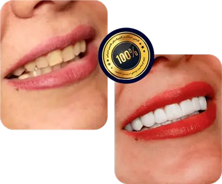 کلینیک دکتر افشین میرزایی قبل و بعد لمینت دندان-کلینیک دندانپزشکی دکتر افشین میرزایی