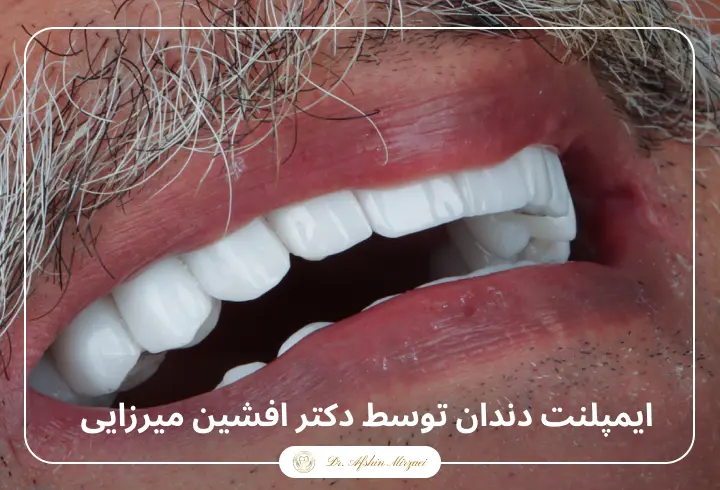 ۸ توصیه مهم برای مراقبت از پروتز دندان | راهنمای بیماران بعد از پروتز مراقبت از پروتز دندان-دندانپزشکی دکتر افشین میرزایی
