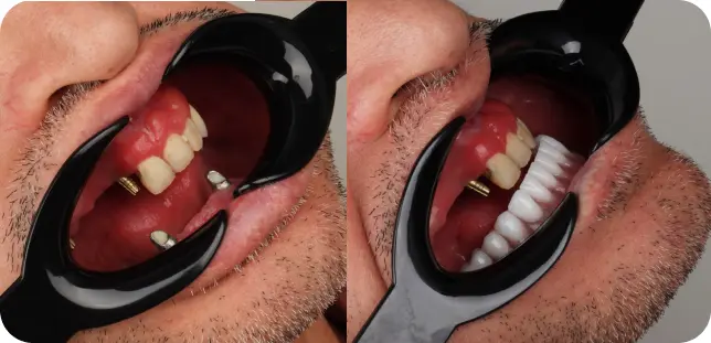 اوردنچر دندان (Overdenture) | مزایا و بهترین مدلهای سال ۱۴۰۴ قبل و بعد از اوردنچر-دکتر افشین میرزایی-دندانپزشکی تهرانپارس